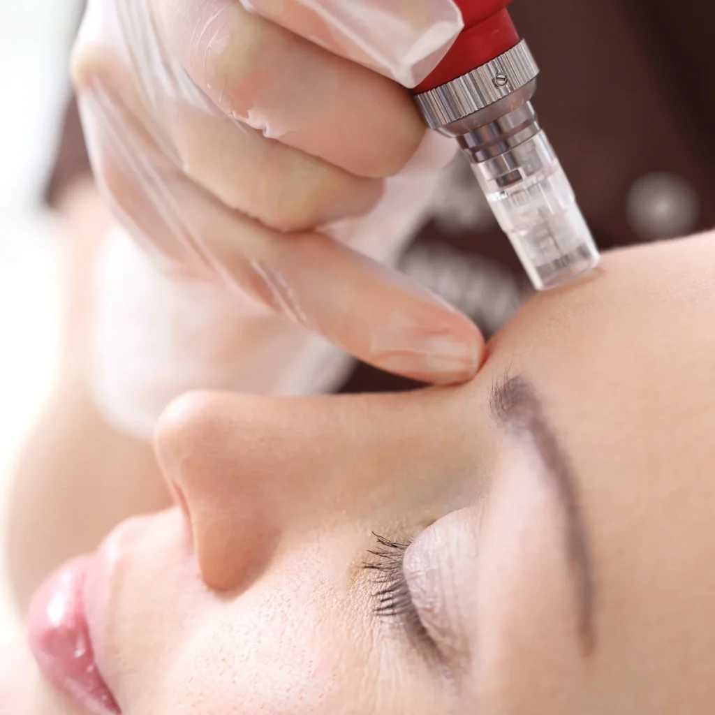 Professional Microneedling services in Woodstock GA for flawless skin